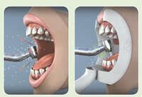 Уникайте перехресного інфікування при лікуванні зубів NaviStom