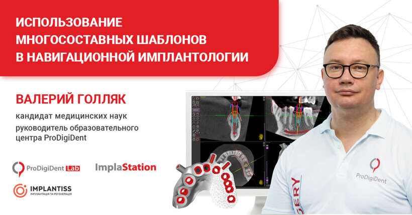 ИСПОЛЬЗОВАНИЕ МНОГОСОСТАВНЫХ ШАБЛОНОВ В ИМПЛАНТОЛОГИИ NaviStom