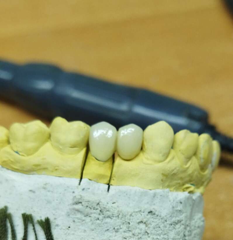 Металокераміка циркон прескераміка акрил нейлон NaviStom