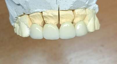 Металокераміка циркон прескераміка акрил нейлон NaviStom