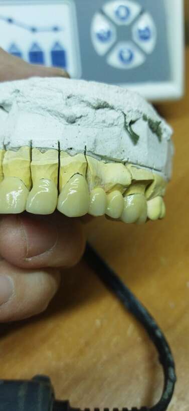 Металокераміка циркон прескераміка акрил нейлон NaviStom