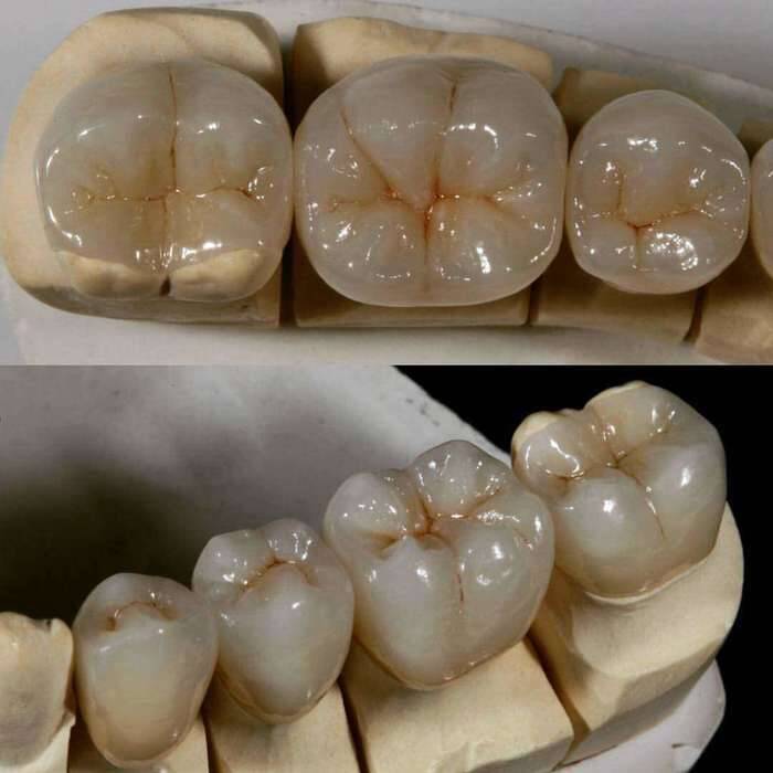 Предлагаем широкий спектр зуботехнических работ, e-max - Zirconia Ceramic. Киев NaviStom