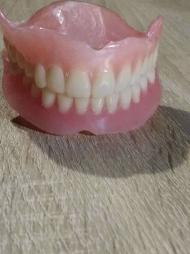 съемное протезирование акриловые,нейлоновые,бюгеля. NaviStom