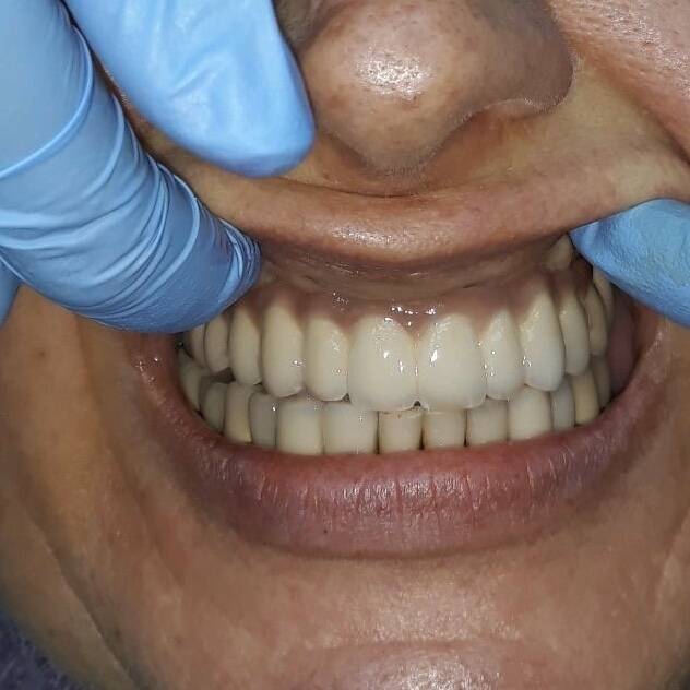 Услуги зуботехнической лаборатории NaviStom