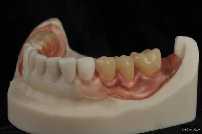 Виготовлення нейлонових протезів NaviStom