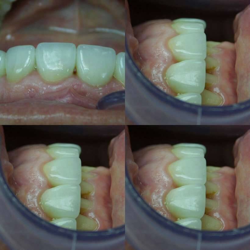 #зубной техник#зубные протезы#металлокерамика#зубы#циркон#E-max#безметал#керамика#импланты#протезиро NaviStom