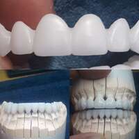 Пресс керамика ( коронки, виниры, накладки) для докторов!!! NaviStom