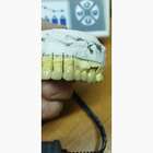 Металокераміка циркон прескераміка акрил нейлон NaviStom